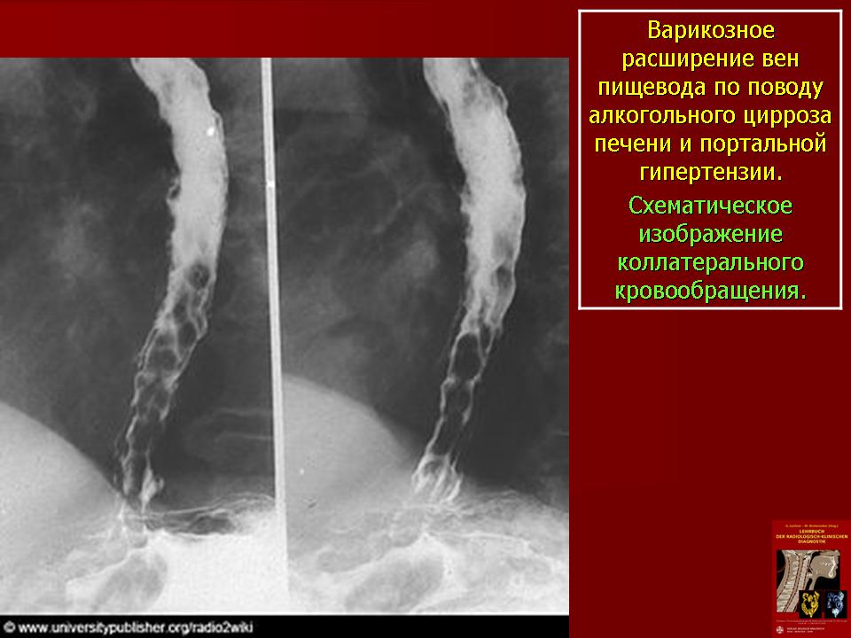 Лигирование Вен Пищевода Диета После