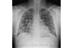 1.nodular_form_of_pulmonary_sarcoidosis.jpg