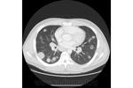 10.nodular_form_of_pulmonary_sarcoidosis.jpg