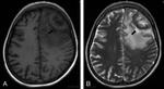 11._tuberkuloma_meningioma..jpg