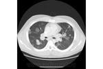 11.nodular_form_of_pulmonary_sarcoidosis.jpg