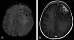 12.._tuberkuloma_meningioma..jpg