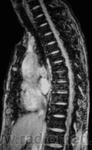 3.fluorosis.jpg