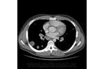 3.nodular_form_of_pulmonary_sarcoidosis.jpg