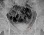 4.1-7-2010_9-40-02_pm.ureterocele.png