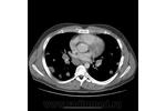 4.nodular_form_of_pulmonary_sarcoidosis.jpg