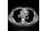 5.nodular_form_of_pulmonary_sarcoidosis.jpg