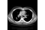 6.nodular_form_of_pulmonary_sarcoidosis.jpg