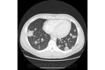 7.nodular_form_of_pulmonary_sarcoidosis.jpg