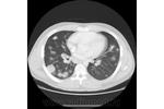 9.nodular_form_of_pulmonary_sarcoidosis.jpg