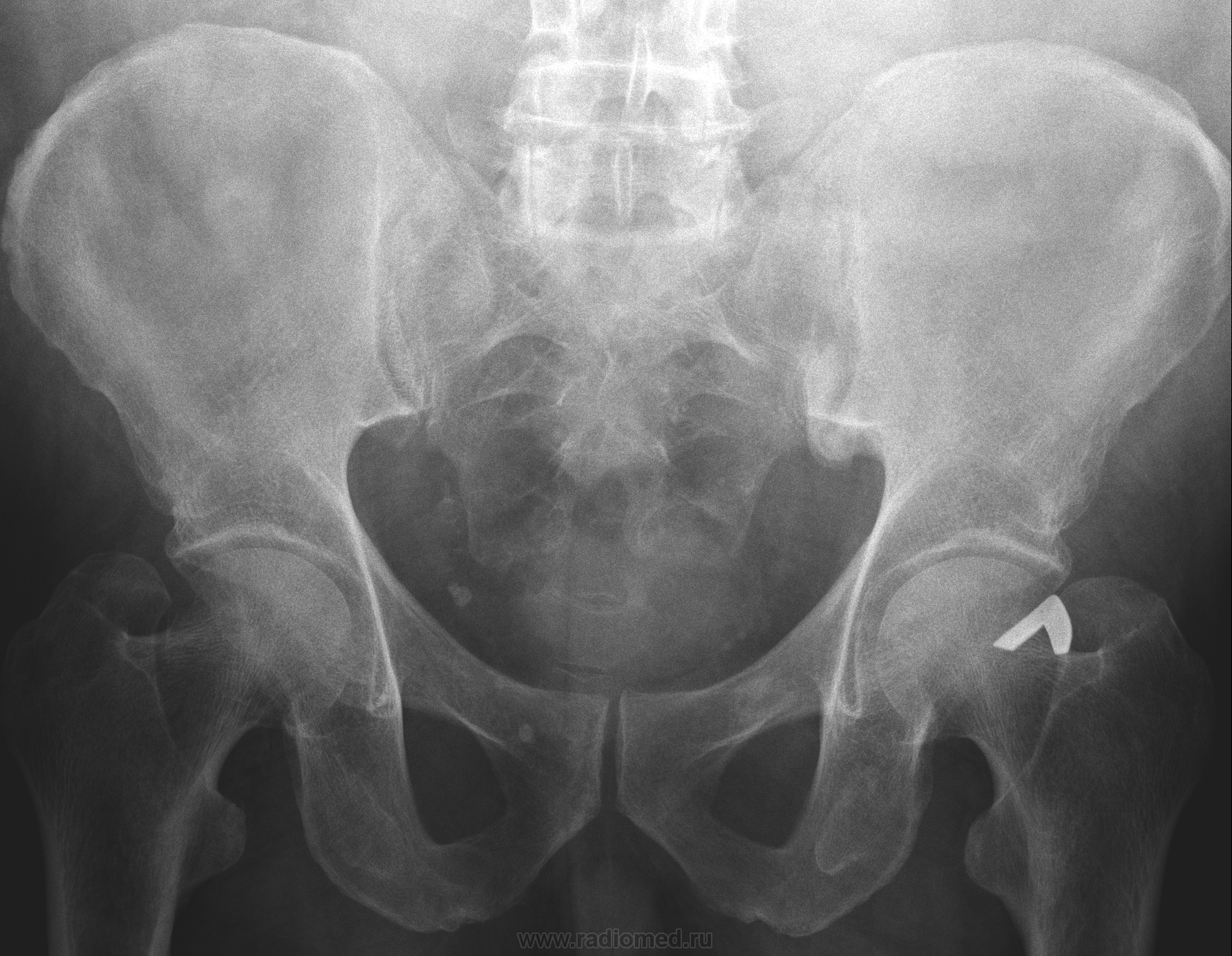 Рентген таза и позвоночника женщины