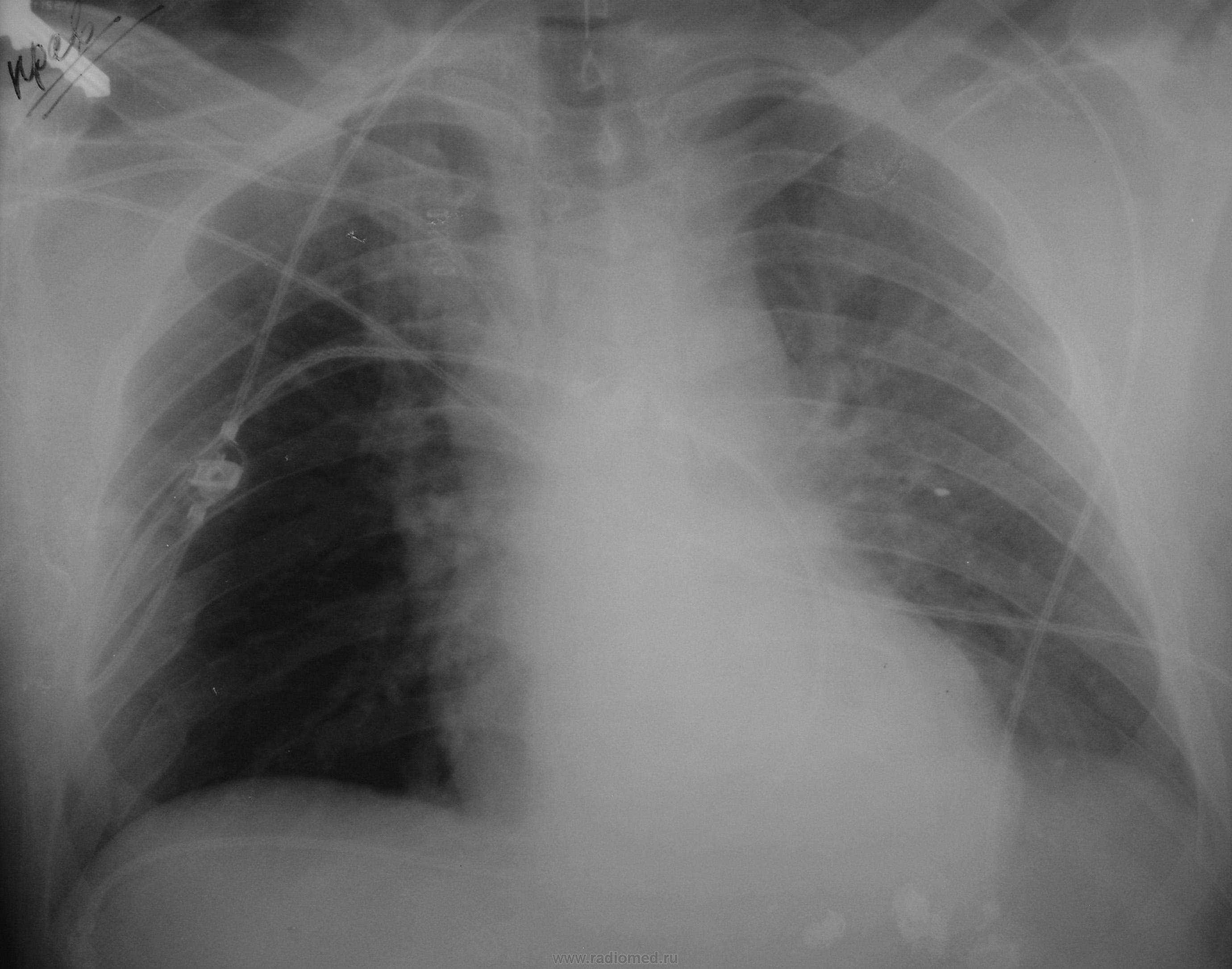 Рентген грудины: укладка, норма, что показывает
