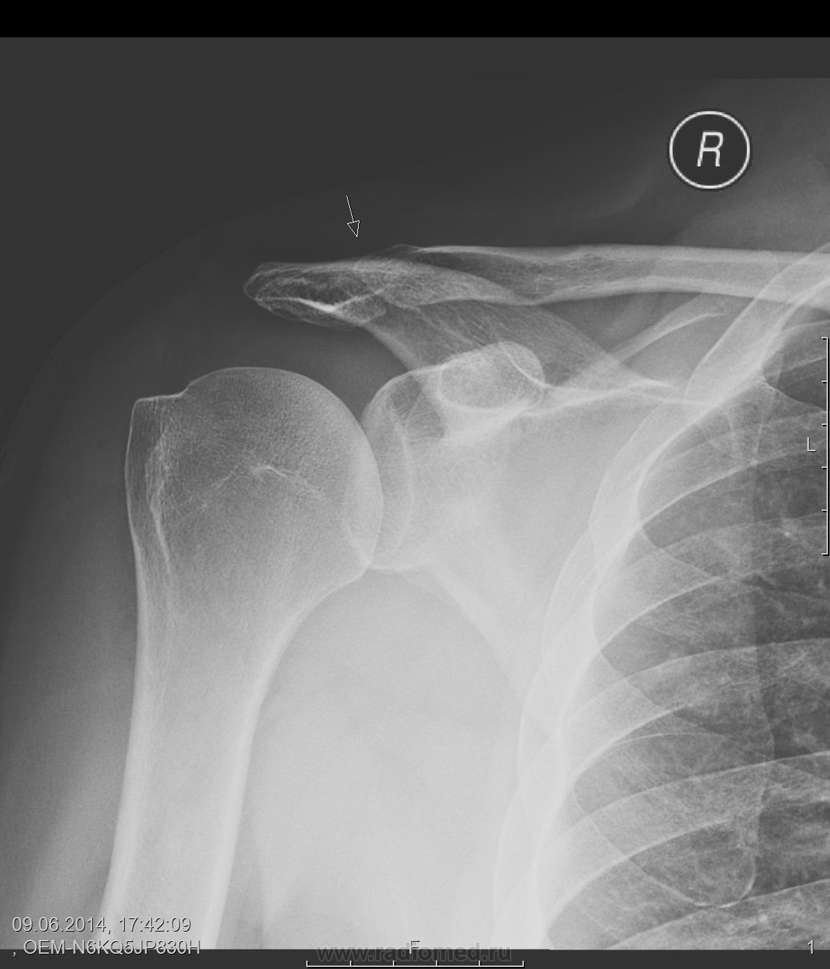 Трансторакальный снимок плеча в боковой проекции