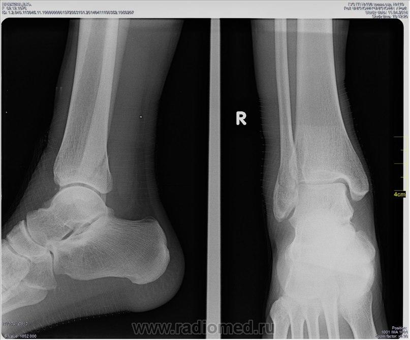 Перелом наружной лодыжки | Портал радиологов