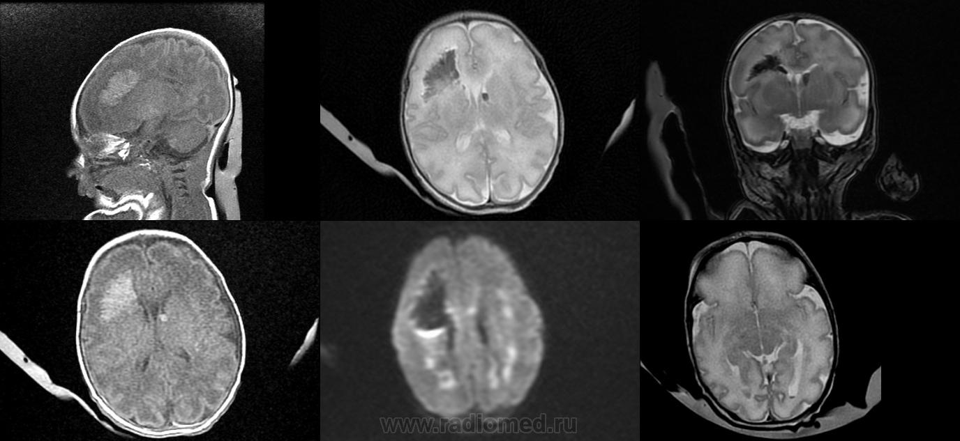 МРТ головного мозга новорожденного. | Портал радиологов