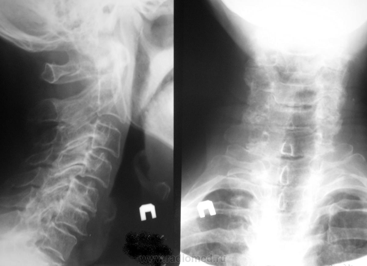 Шейный остеохондроз | Портал радиологов
