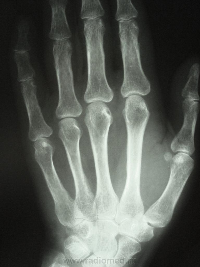 Рентген кисти руки: подготовка к проведению, расшифровка и нормальные показатели