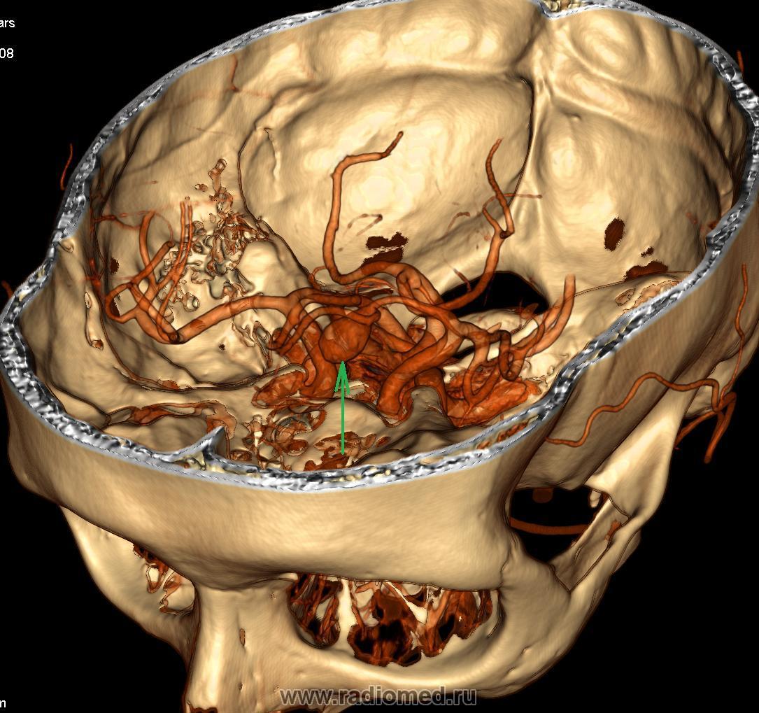 ГМ. Аневризмы сосудов головного мозга. Набор изображений. + | Портал  радиологов