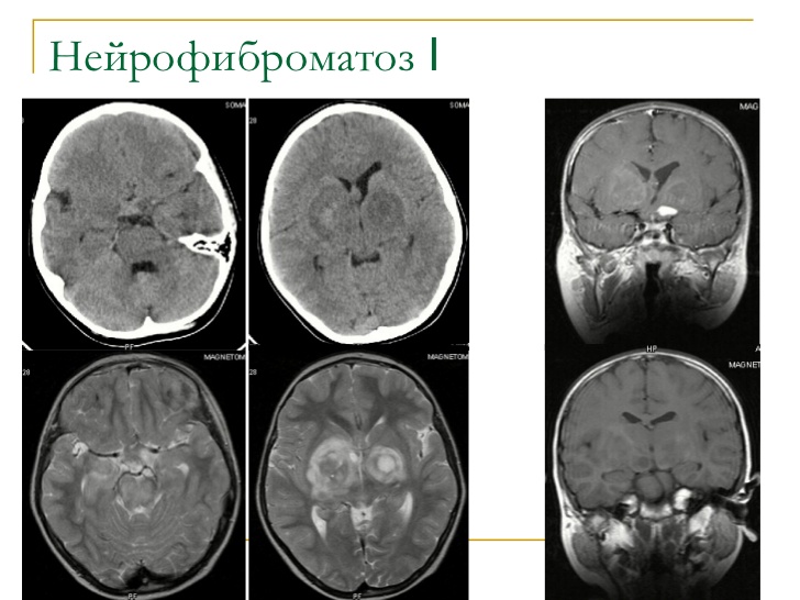 Диета При Нейрофиброматозе 1