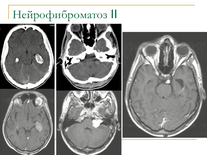 Диета При Нейрофиброматозе 1