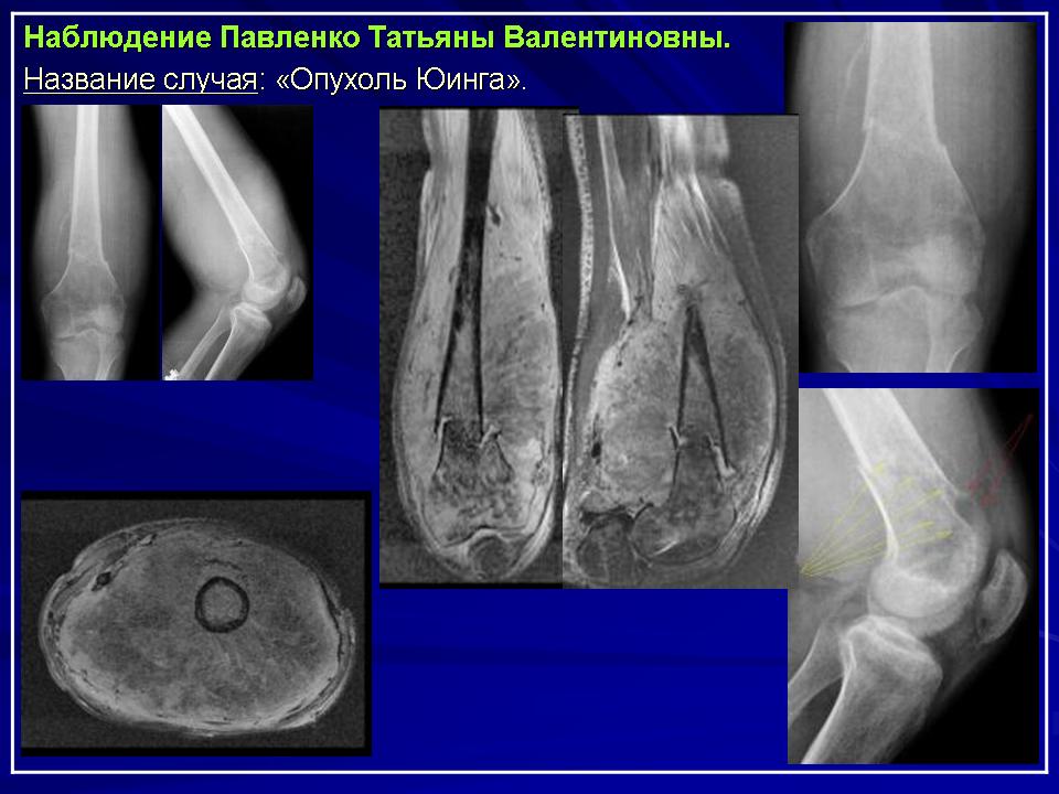 Саркома Эвинга (Юинга) в детском возрасте