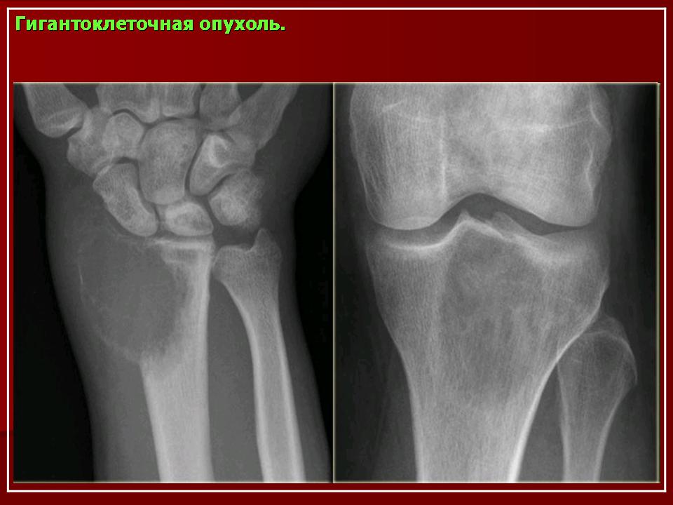 Рентгенологическая картина гигантоклеточной опухоли характеризуется разновидностями