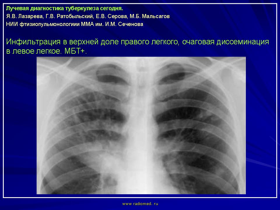 Лучевая диагностика это. Инфильтративный туберкулез легкого с1-2. Инфильтративно-пневмонический туберкулёз лёгких. Инфильтративный туберкулез рентген. Легочный инфильтрат рентген.