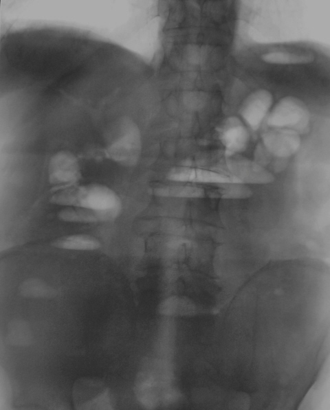 Инородное тело брюшной полости после операции. Рентген брюшной полости инородное тело. Свободный ГАЗ В брюшной полости рентген. Рентгеновский снимок брюшной полости человека. Воздух в брюшной полости на рентгене.