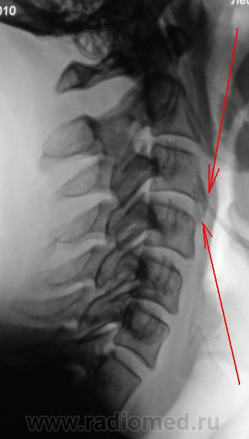 Шейный отдел позвоночника рентген. Рентген дорсального отдела позвоночника. Нестабильность шейного отдела рентген. Нестабильность шейного отдела позвоночника рентген. Смещение позвонков шейного отдела рентген.