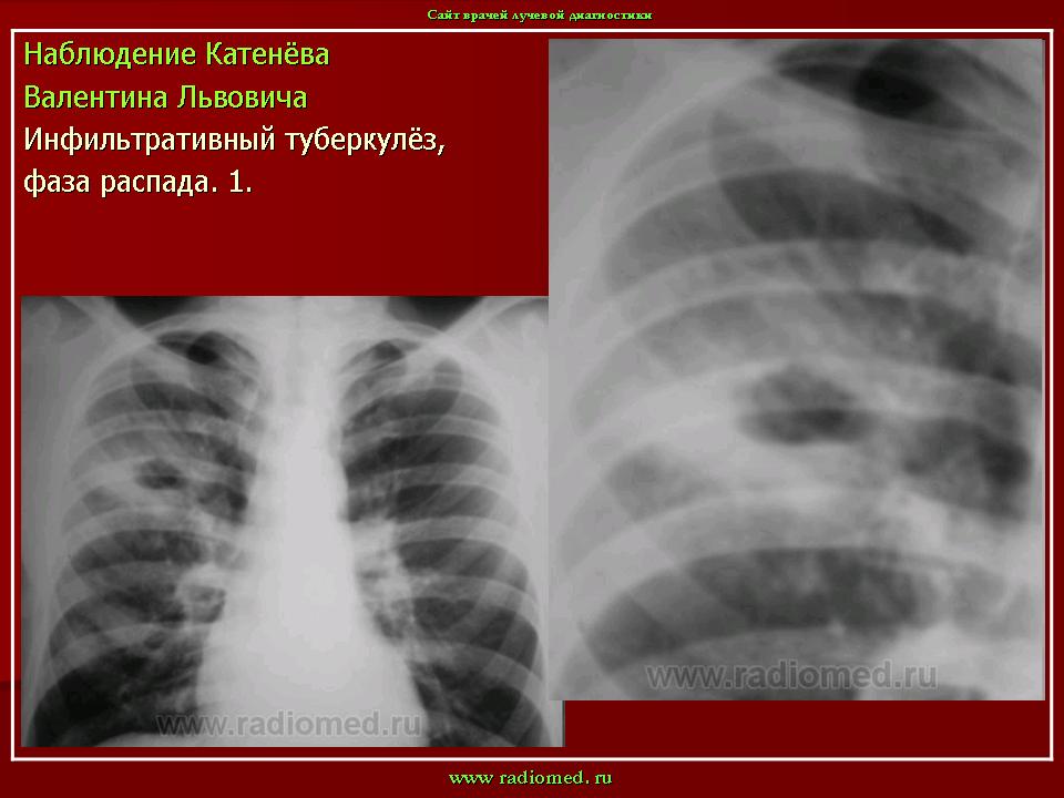 Инфильтративный распад легких. Инфильтративный туберкулез фаза обсеменения. Фаза обсеменения туберкулеза на рентгене. Инфильтративный туберкулез легких s1-2. Инфильтративный туберкулез легких в фазе распада кт.