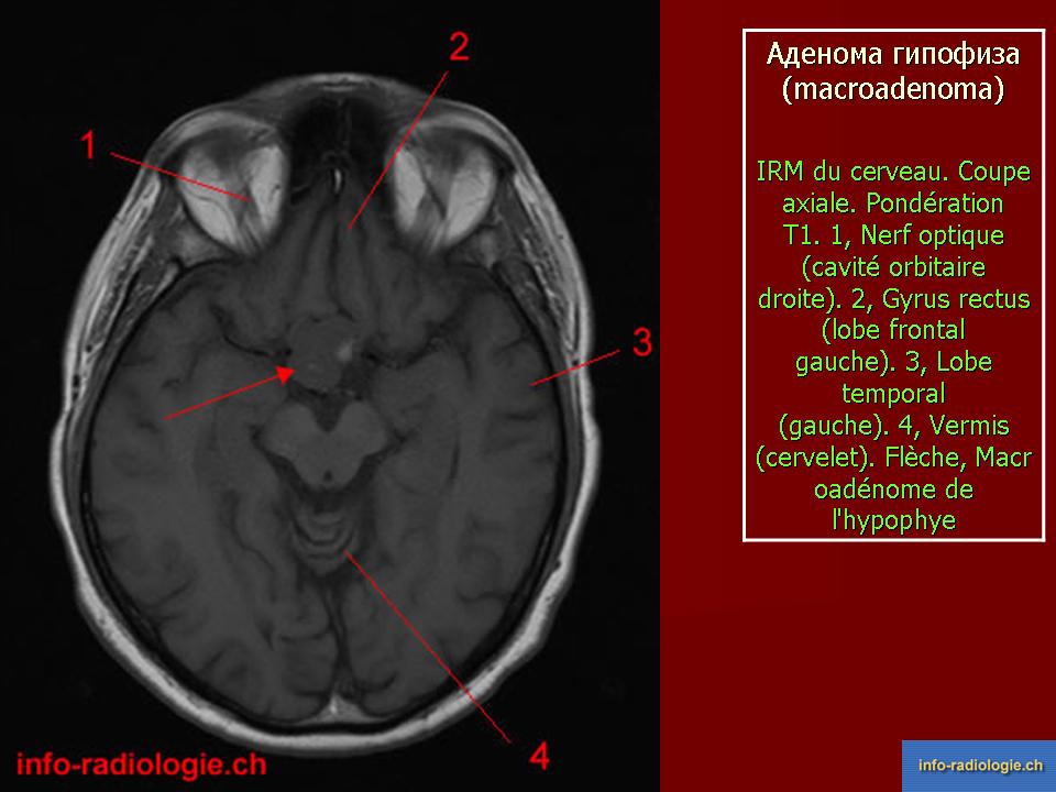 Мр картина микроаденомы гипофиза что это