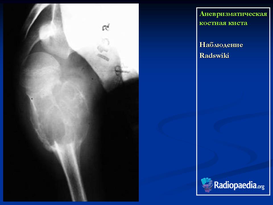 Киста кости. Аневризматическая костная киста бедренной кости кт. Аневризматическая костная киста рентген.