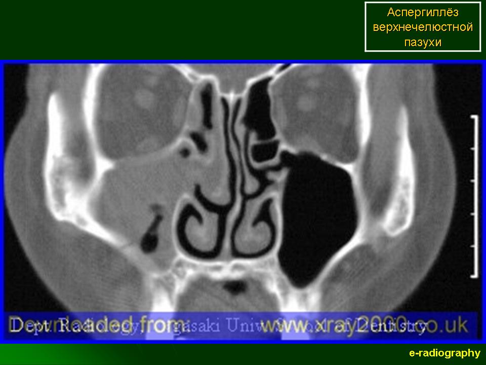 Киста верхнечелюстной пазухи на кт фото