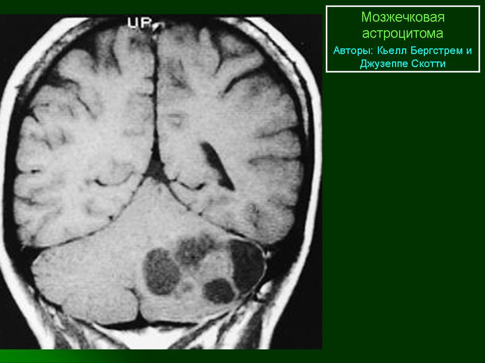 Астроцитома головного мозга прогноз. Анапластическая астроцитома лобной доли. Астроцитома головного мозга кт. Мрт астроцитома лобной доли.