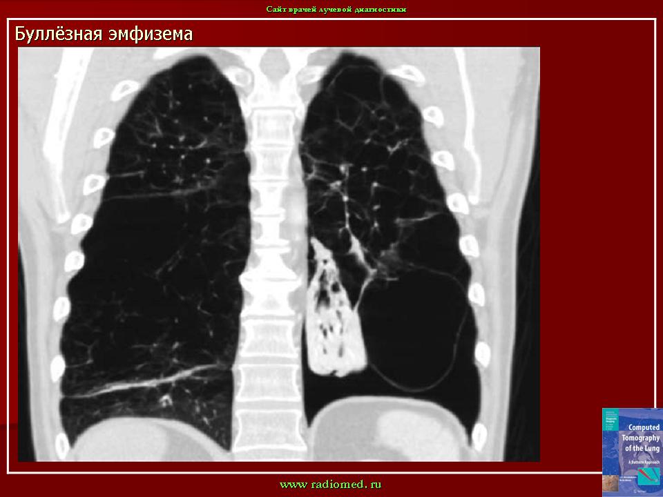 Булезная эмфизема легких. Буллёзная эмфизема лёгких кт что это. Буллезная эмфизема легких кт. Буллезная эмфизема мкб.