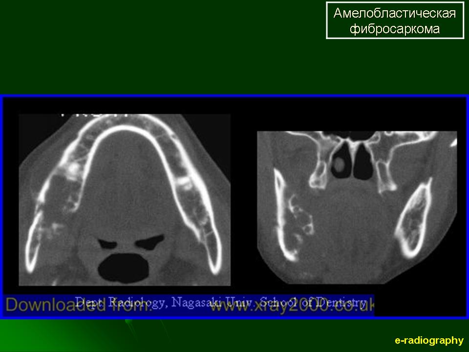 Фибросаркома. Амелобластическая фиброма верхней челюсти. Амелобластная фибросаркома. Амелобластическая фиброма рентген.