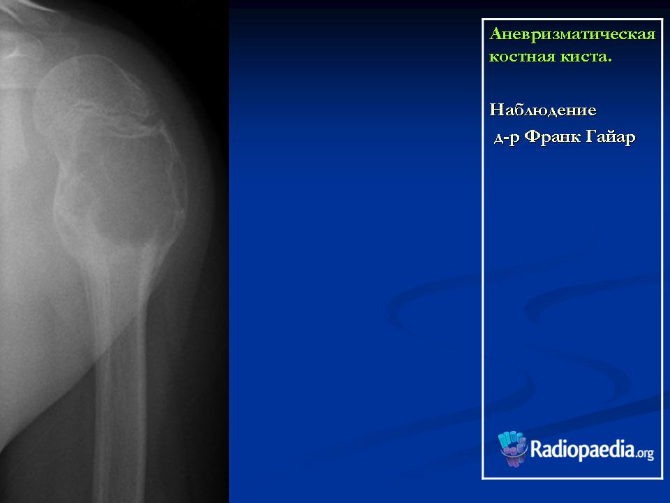 Костная киста. Аневризматическая киста плечевой кости рентген. Аневризмальная костная киста кт.