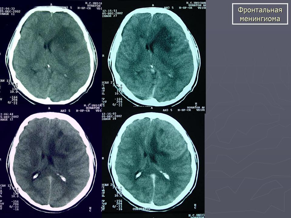 Менингиома головного мозга продолжительность операции