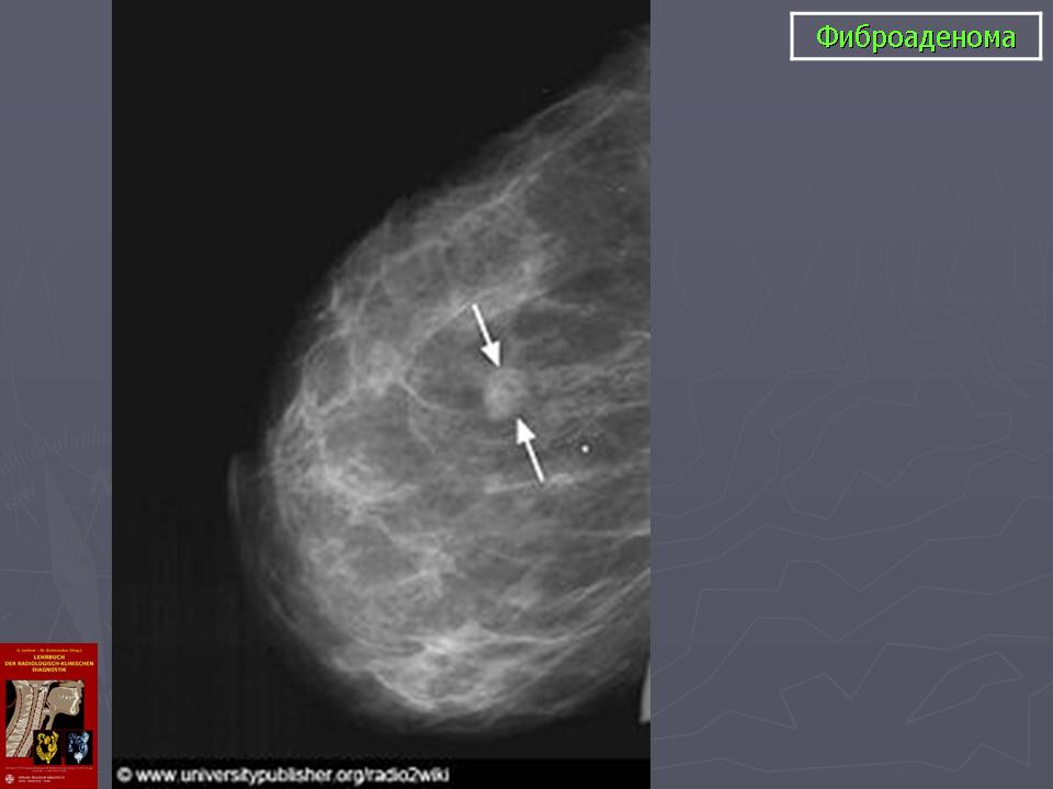 Фиброма в груди. Липома молочной железы маммография УЗИ. Фибролипома молочной железы маммография. Фиброаденома молочной железы маммография.