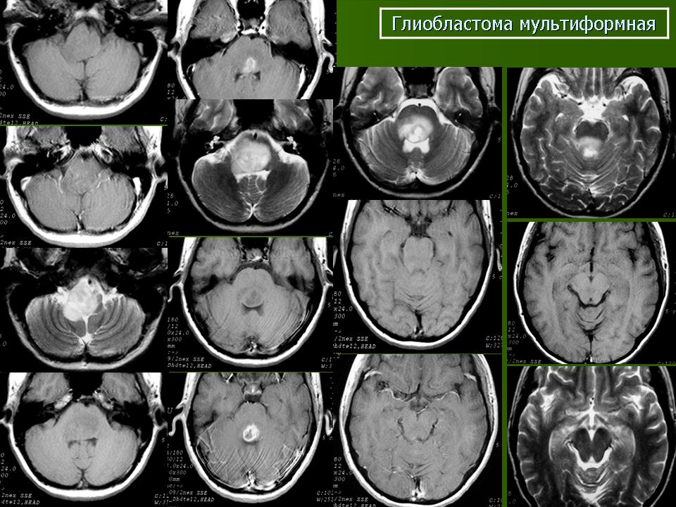 Глиобластома психосоматика. Мультиформной глиобластомы. Мультиформная глиобластома ГИСТ. Мультиформная экссудативная эритема. Глиобластома мультиформная знаменитости.