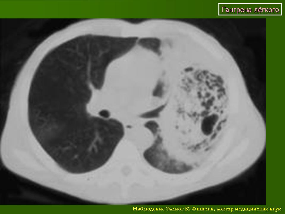 Гангрена легкого. Гангренозный абсцесс легкого кт. Гангрена легкого компьютерная томография.