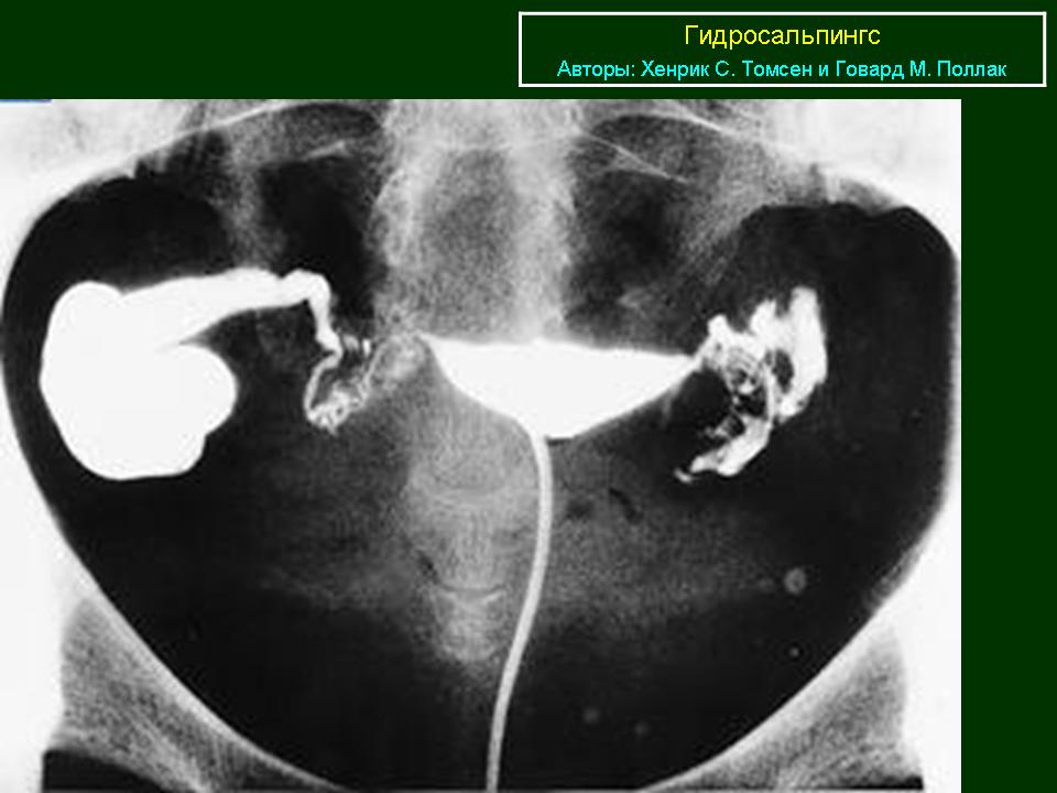 Повышенный проходимы. Гистеросальпингография гидросальпинкс. Гидросальпинкс ГСГ рентген. Гидросальпинкс маточных труб.