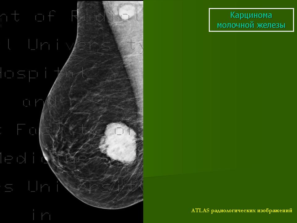 Как выглядит рак молочной железы на поверхности фото