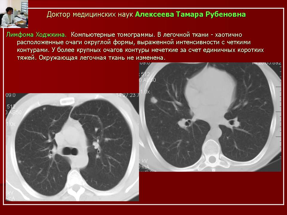 Очаги на кт легких форум. Поражение легких при лимфоме кт.