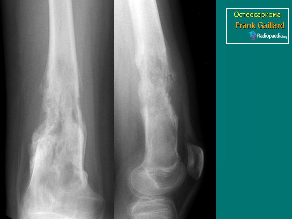 Степени саркомы. Остеосаркома (остеогенная саркома). Остеосаркома бедренной кости рентген.