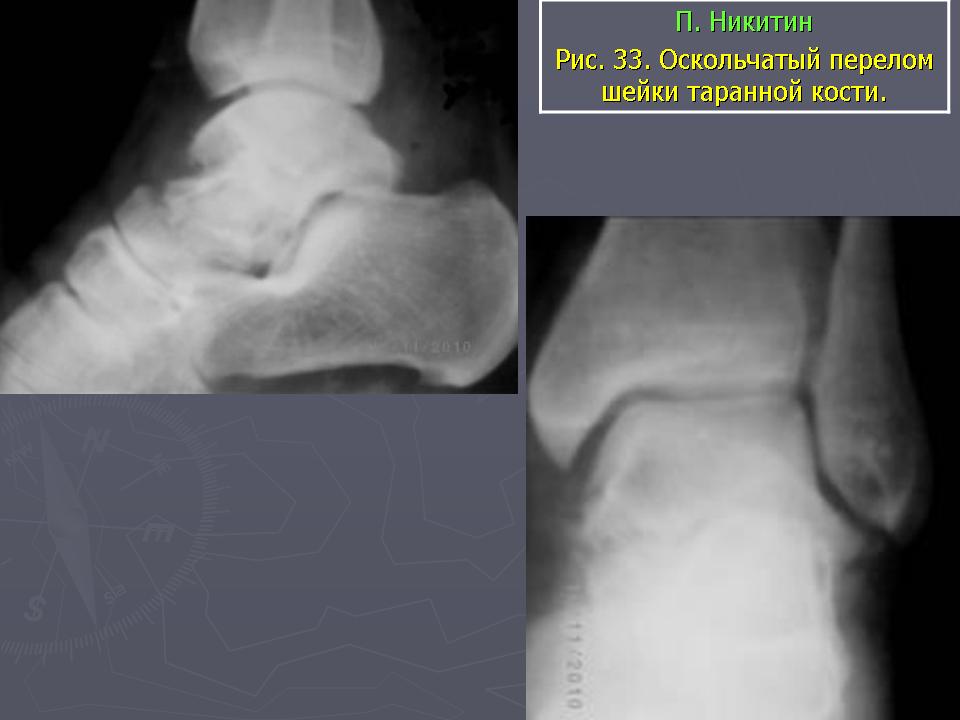Перелом пятка кость без смещения картинка