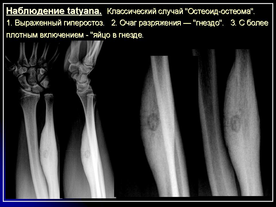 Опухоли лучевой кости. Остеомиелит локтевого сустава рентген. Опухоли большеберцовой кости остеома. Остеома лучевой кости рентген.