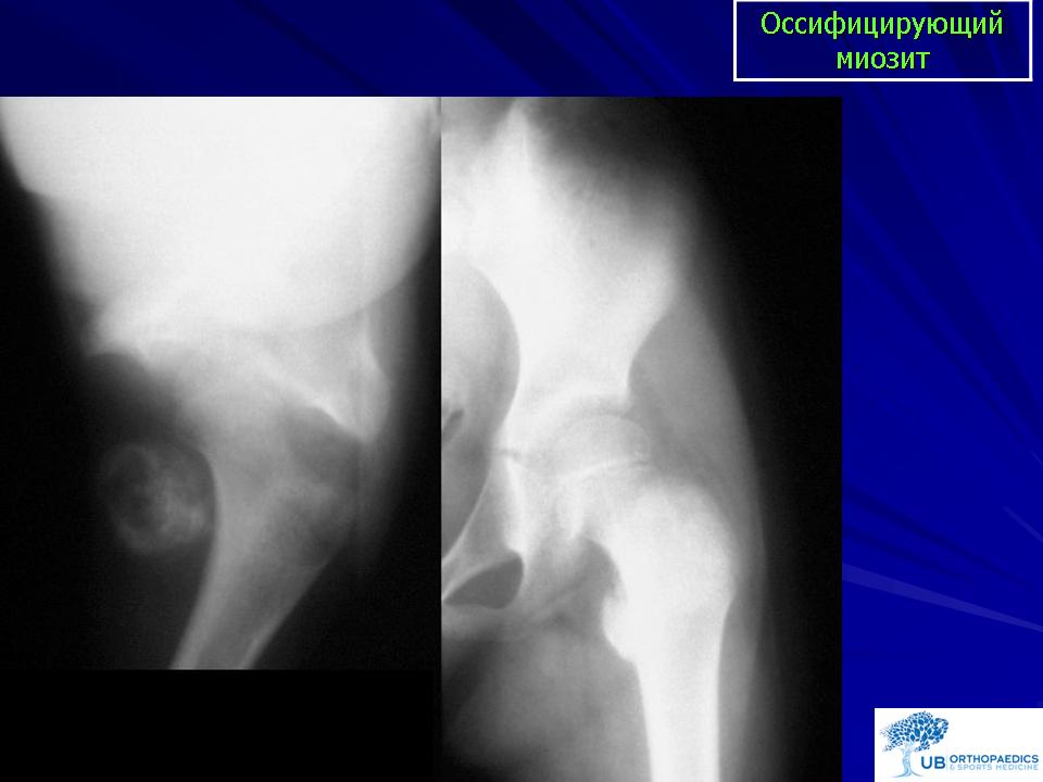 Миозит суставов. Оссифицирующий миозит коленного сустава. Оссифицирующий миозит рентген. Миозит оссифицирующий травматический. Оссифицирующий миозит левой бедренной кости.