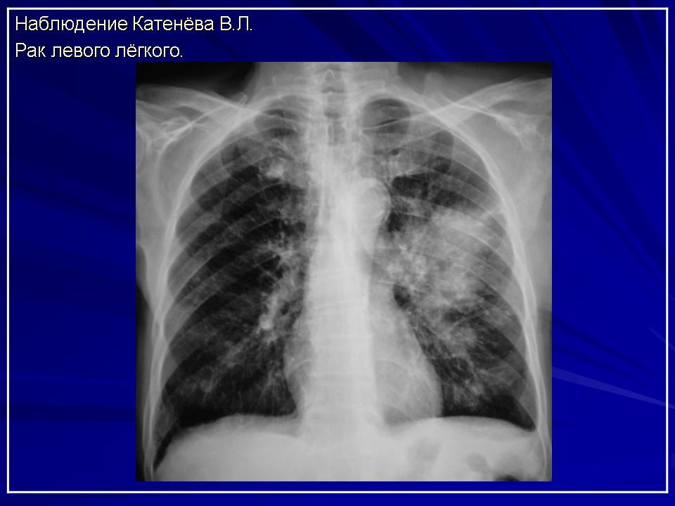 Как выглядят метастазы в легких на рентгене у человека фото