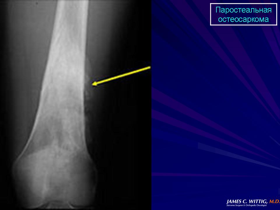 Остеосаркома коленного сустава фото